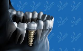 Implantology