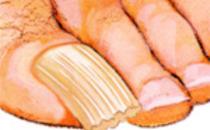 Fungal Nails Toenail fungus, or onychomycosis, is an infection underneath the surface of the nail caused by fungi. When the tiny organisms take hold, the nail often becomes darker in color and smells foul. Source: www.apma.org